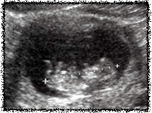 My second ultrasound Jan 28, 2004-10 weeks